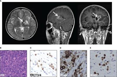 Gene mutation landscape of a rare patient with acute megakaryoblastic leukemia after treatment of intracranial germ cell tumor